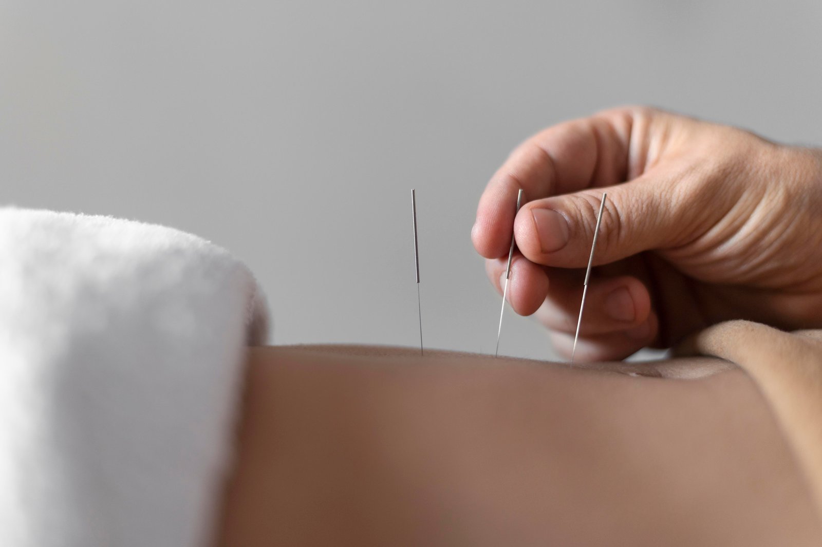Acupuncture in Hamilton
